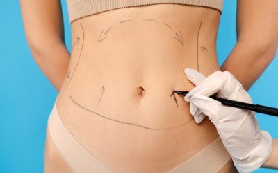 What to Expect 8 Weeks After Liposuction